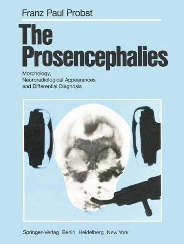 Prosencephalies